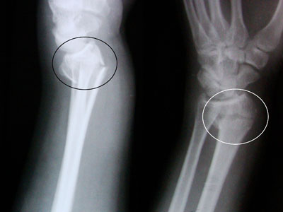 forearm-fractures
