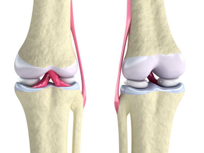 knee-meniscus-tear